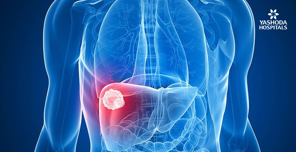 How can one survive liver cancer ?