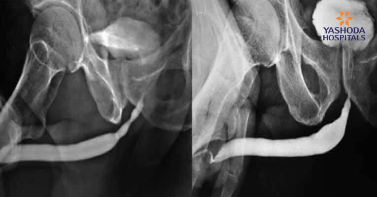 Buccal epithelium Expanded and Encapsulated in Scaffold-Hybrid Approach to Urethral Stricture (BEES-HAUS) procedure