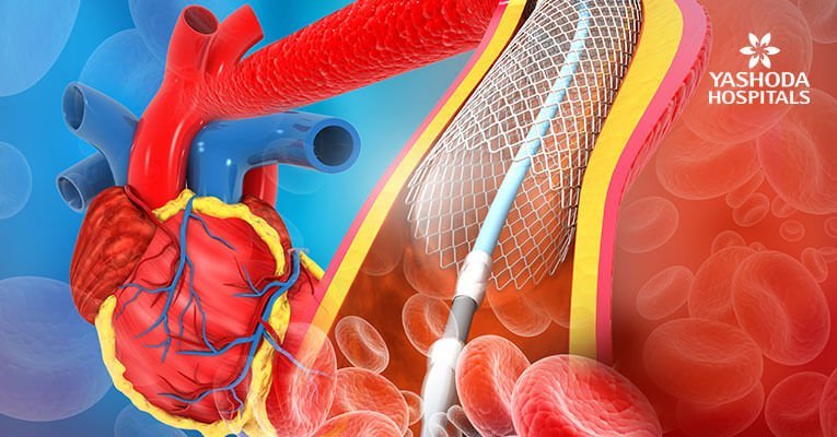 Onyx in post-CABG & post-PTCA patient with distal LMCA edge stenosis of stent