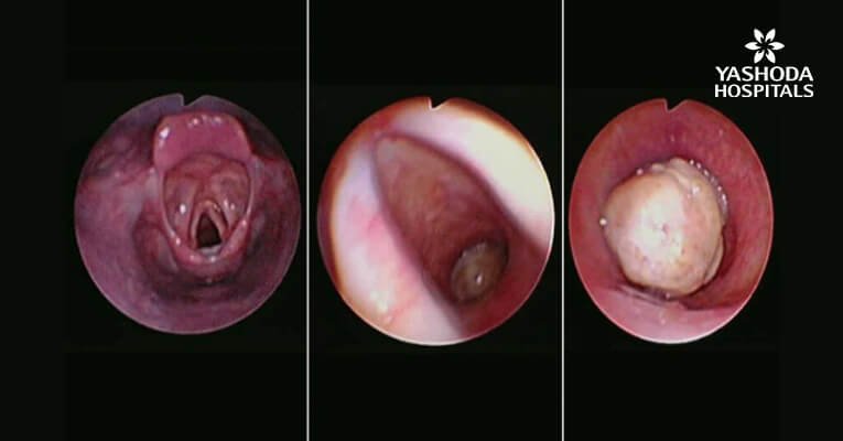 Bronchoscopic Management of Primary Tracheal Tumor