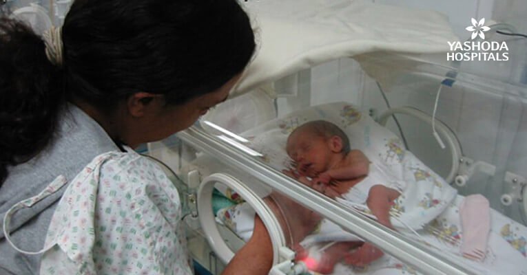 Ileostomy in a premature twin girl born with low birth weight
