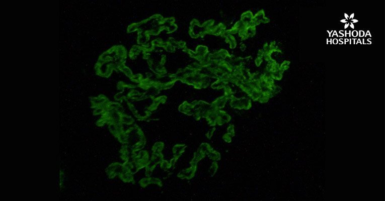 Interesting Case of Systemic Lupus Erythematosus With APS Nephropathy