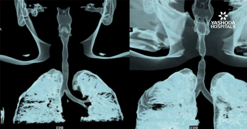 Case of post-intubation tracheal stenosis treated effectively with rigid bronchoscopic balloon bronchoplasty