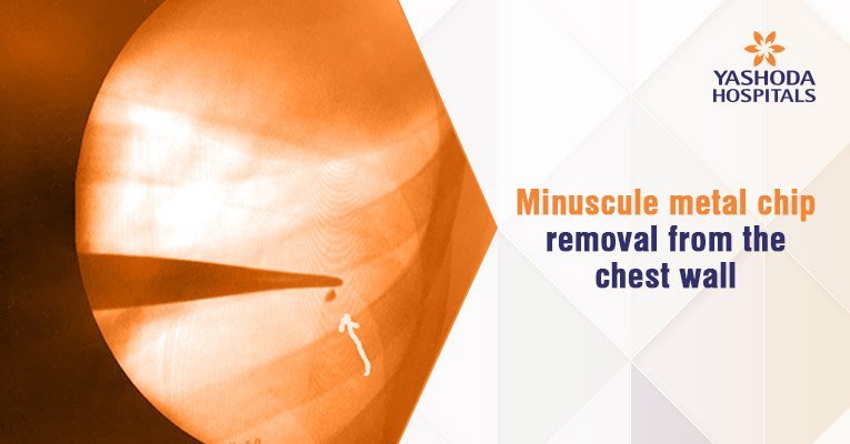 Robotic thoracic surgery to remove the metallic particle
