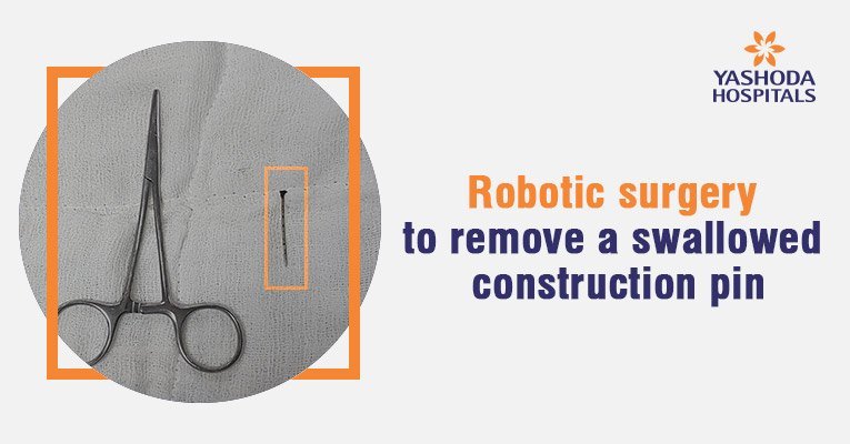 Robotic surgery saves the life of a priest who swallowed a construction pin