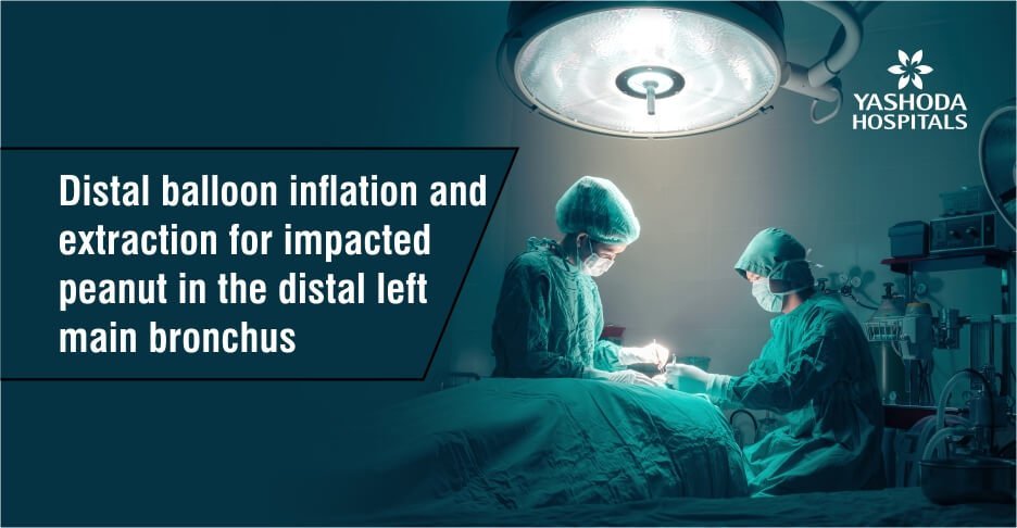 Distal balloon inflation and extraction for impacted peanut in the distal left main bronchus