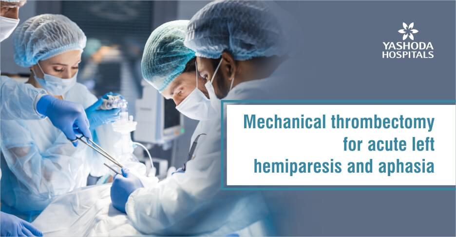 Mechanical thrombectomy for acute left hemiparesis and aphasia