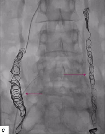 pelvic congestion syndrome