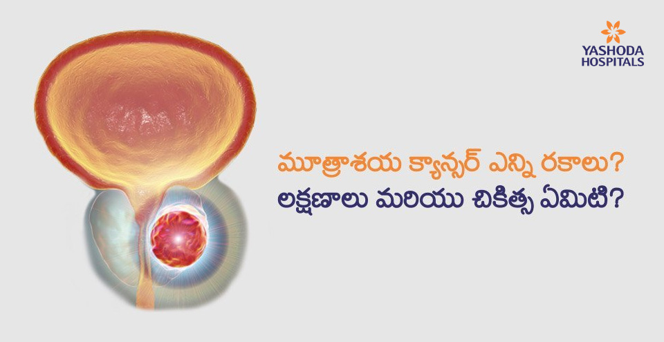 మూత్రాశయ క్యాన్సర్ మరియు దాని చికిత్సలు