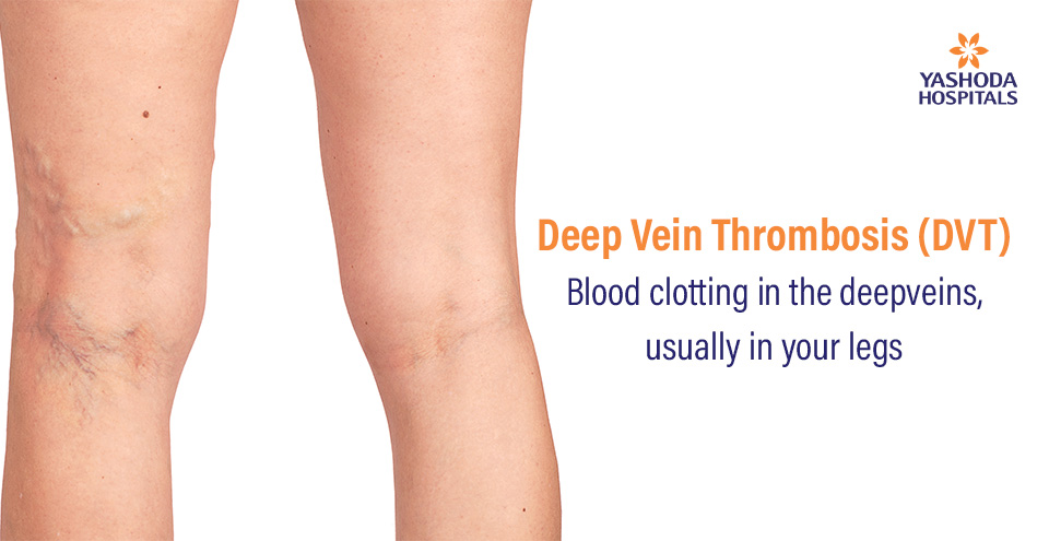 Deep Vein Thrombosis (DVT)