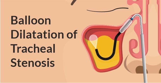 Balloon Dilatation of Tracheal Stenosis