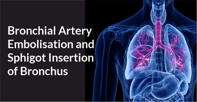 Bronchial Artery Embolisation and Sphigot Insertion of Bronchus