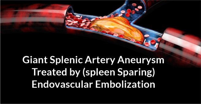 Giant Splenic Artery Aneurysm Treated by (Spleen Sparing) Endovascular Embolization