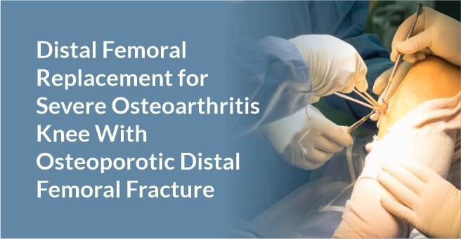 Distal Femoral Replacement for Severe Osteoarthritis Knee With Osteoporotic  Distal Femoral Fracture