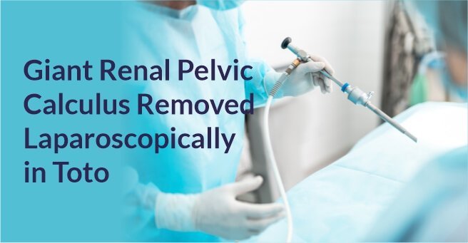 Giant Renal Pelvic Calculus Removed Laparoscopically  in Toto