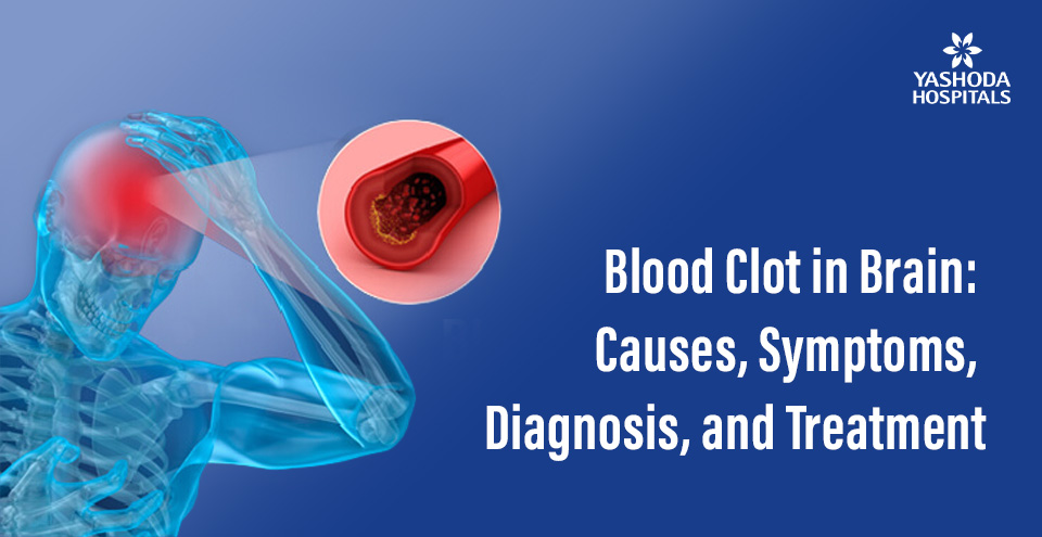 Blood Clot in Brain: Causes, Symptoms, Diagnosis, and Treatment