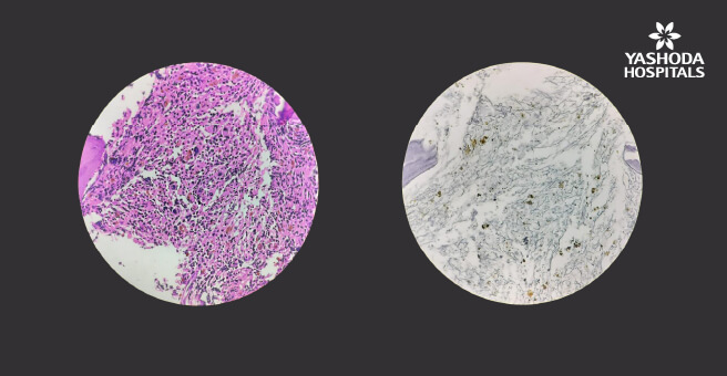 Auto-immune Myelofibrosis