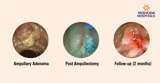 endoscopic-ampullectomy1