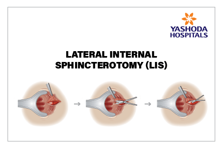 Lateral Internal Sphincterotomy (LIS)