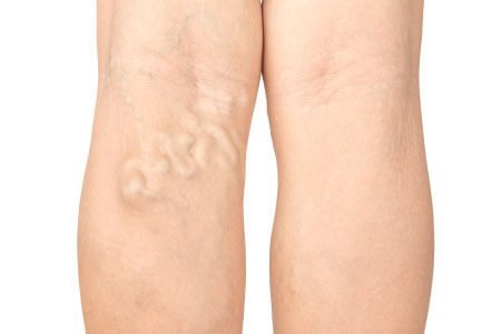 Deep Vein Thrombosis 01