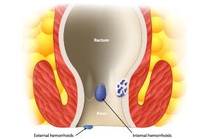 Hemorrhoids or Piles  class=