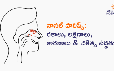 నాసల్ పాలిప్స్: రకాలు,  లక్షణాలు, కారణాలు & చికిత్స పద్దతులు