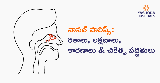 Nasal Polyps Symptoms, Causes, Treatment_telugu banner