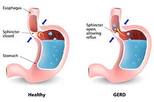 Gastritis and Gastrointestinal Reflux Diseases  class=