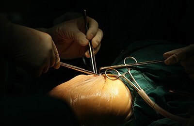 Knee replacement surgery  class=
