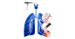 Latest Advancements in Interventional Pulmonology
Bronchoscopic Thermal Vapour Ablation (BTVA)