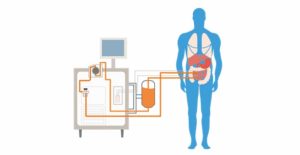 Precision Cancer Care - HIPEC
(Hyperthermic Intraperitoneal Chemotherapy)