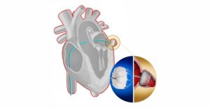 Left Atrial Appendage Closure (LAAC) For Stroke Prevention