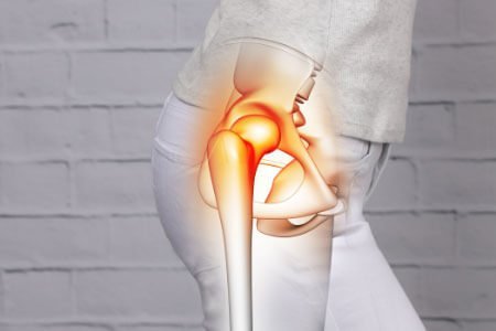 Slipped capital femoral epiphysis