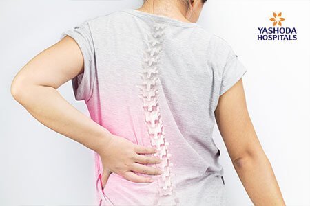 Scoliosis  class=