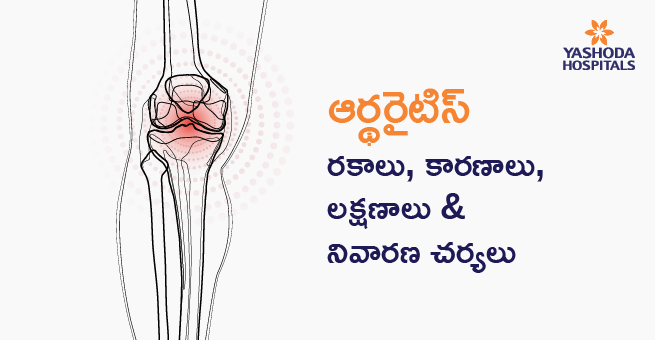 ఆర్థరైటిస్ (కీళ్లవాతం): రకాలు, కారణాలు, లక్షణాలు & నివారణ చర్యలు