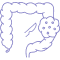 Colorectal Cancer