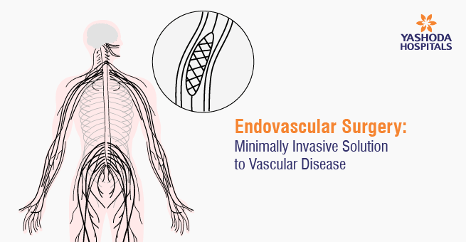 Endovascular Surgery Main Banner