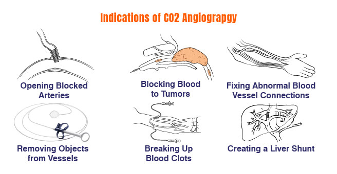 Angiography