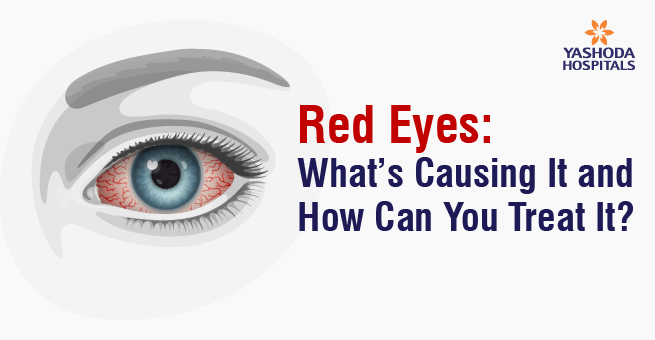 Red Eyes: What’s Causing It and How Can You Treat It?