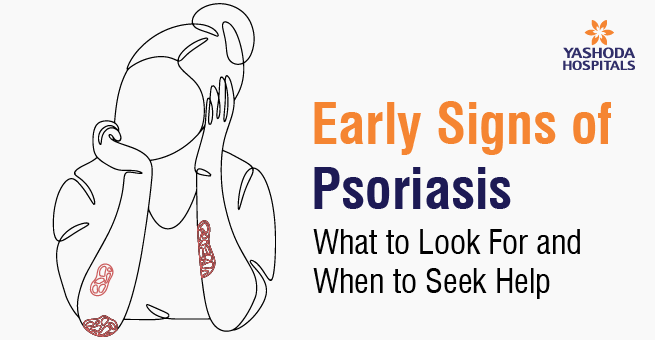 Early Signs of Psoriasis: What to Look For and When to Seek Help