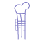 Humerus Plating Surgery