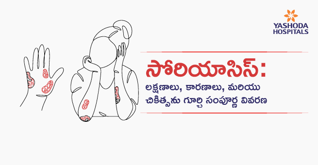 సోరియాసిస్: లక్షణాలు, కారణాలు, మరియు చికిత్సను గూర్చి సంపూర్ణ వివరణ