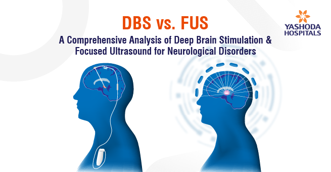 DBS vs. FUS: A Comprehensive Analysis of Deep Brain Stimulation & Focused Ultrasound for Neurological Disorders