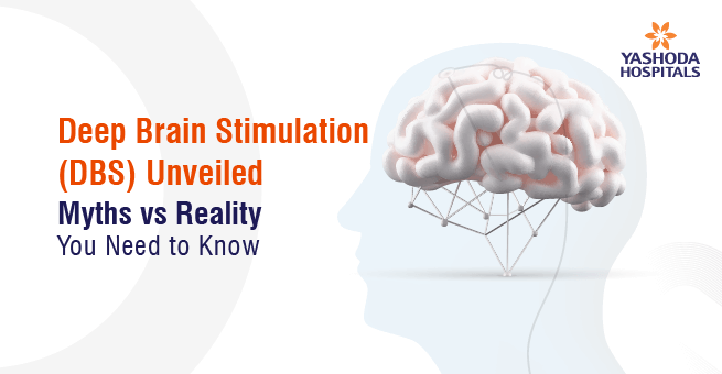 Deep Brain Stimulation (DBS) Unveiled: Myths vs. Reality You Need to Know