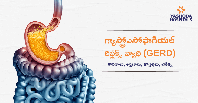 గ్యాస్ట్రోఎసోఫాగియల్ రిఫ్లక్స్ వ్యాధి (GERD) : కారణాలు, లక్షణాలు, జాగ్రత్తలు, చికిత్స