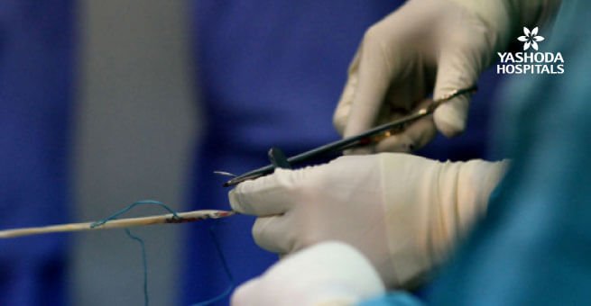 surgical procedure for ACL surgery