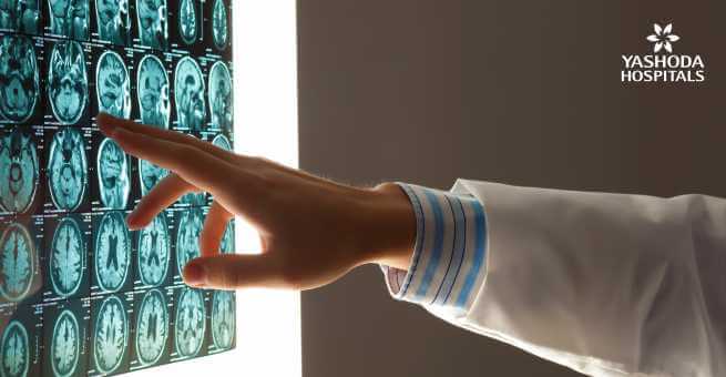 Breast Cancer diagnosed in men