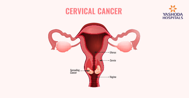 Cervical cancer