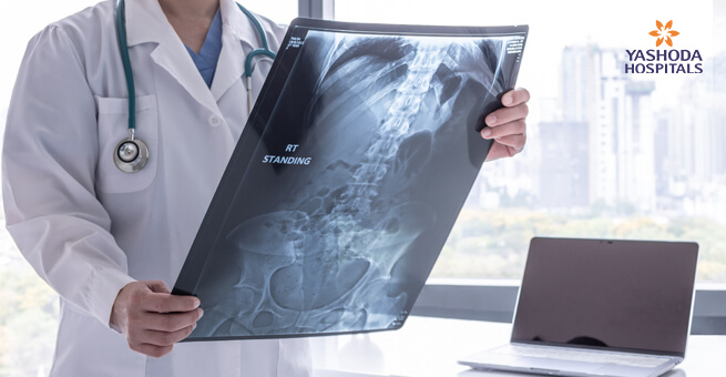 How to Detect Esophageal Cancer