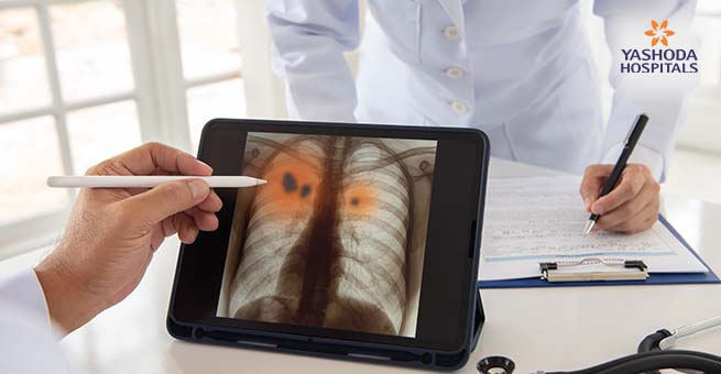 How to Detect Lung Cancer